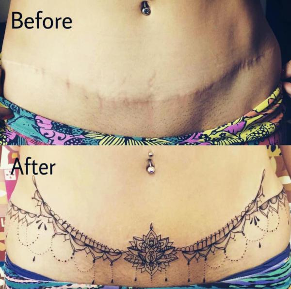 Tummy Tuck Tattoo What You Need To Know Art And Design